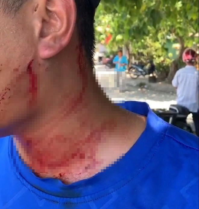 Phụ xe buýt Huế- Đà Nẵng bất ngờ bị lái xe ô tô 7 chỗ dùng tay kẹp cổ để 2 người còn lại nhặt đá và dùng chìa khóa xe đánh, chọc vào dưới mang tai và phía sau đầu