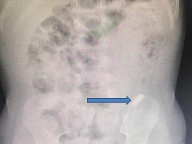 Sức khỏe đời sống - 2 ngày nín thở lấy mảnh gương vỡ khỏi bụng bé trai 10 tháng tuổi