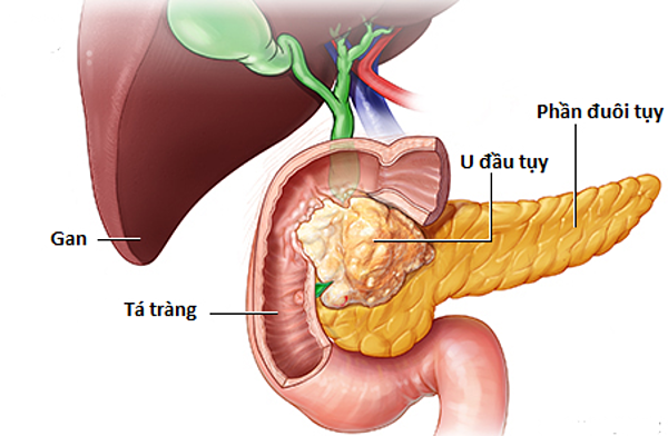 Căn bệnh khiến diễn viên 'Chạy án' Khôi Nguyên qua đời nguy hiểm thế nào? - 2