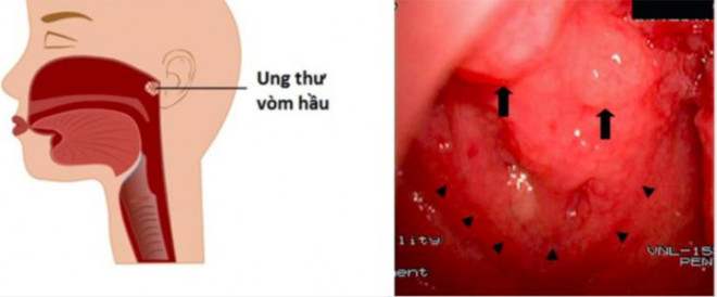 Dấu hiệu "chỉ điểm" căn bệnh ung thư mỹ nam "Người thừa kế" phải chống chọi hơn 3 năm - 2