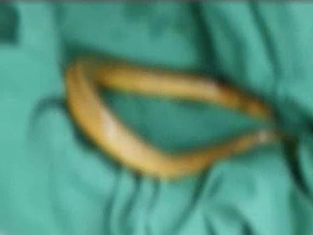 Phi thường - kỳ quặc - Người đàn ông nhét lươn sống vào "chỗ hiểm" để chữa bệnh và cái kết kinh hoàng