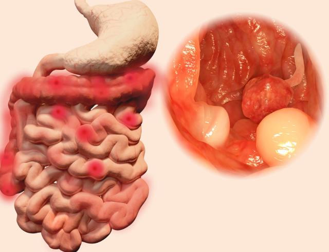 Đi vệ sinh có 3 dấu hiệu này, coi chừng ung thư ruột "gõ cửa" - 2