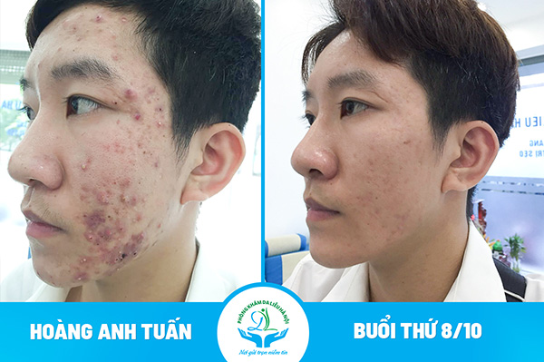 Hình ảnh trước và sau của bệnh nhân điều trị mụn tại Phòng khám da liễu Hà Nội