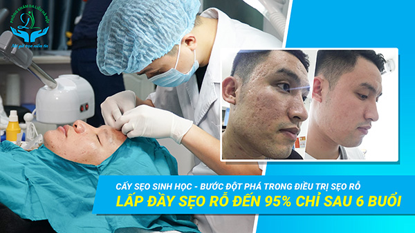 Hình ảnh trước và sau của bệnh nhân điều trị sẹo rỗ tại Phòng khám da liễu Hà Nội