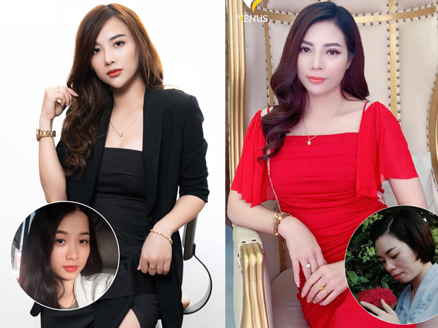 Tư vấn làm đẹp - 3 cô gái "vịt hoá thiên nga", đổi đời nhờ phẫu thuật thẩm mỹ