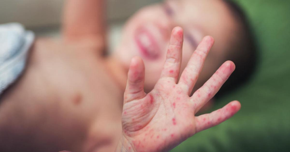 Sức khỏe đời sống - Trẻ mắc tay chân miệng tăng vọt, Bộ Y tế yêu cầu khẩn cấp