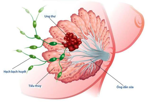 Diễn viên chính tài sắc vẹn toàn trong Hồng Lâu Mộng ra đi vì ung thư vú, những ai dễ mắc bệnh này? - 2