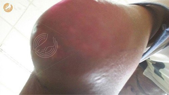 U cục Tophi ở tay quá to khiến anh khó vận động phải đi mổ (Ảnh: NVCC)