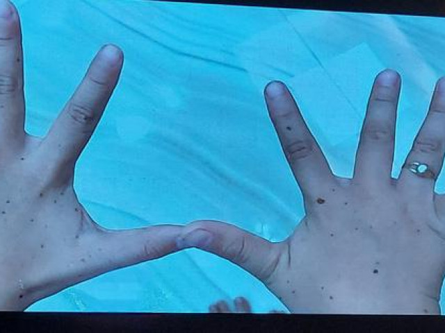 Sức khỏe đời sống - Bé gái mắc hội chứng da báo, toàn thế giới chỉ có khoảng 200 ca