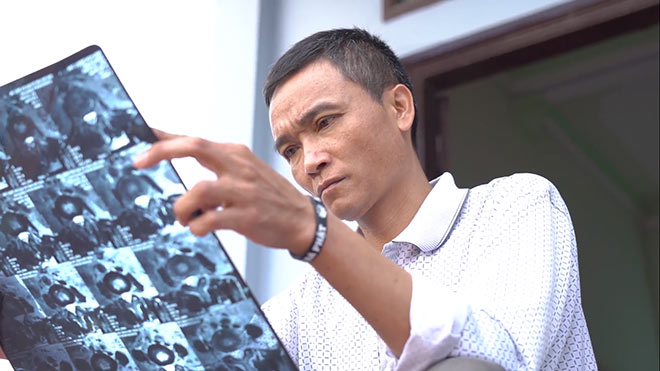 Xẹp đốt sống mà không cần phải mổ chỉ vì nhờ thứ này - 4