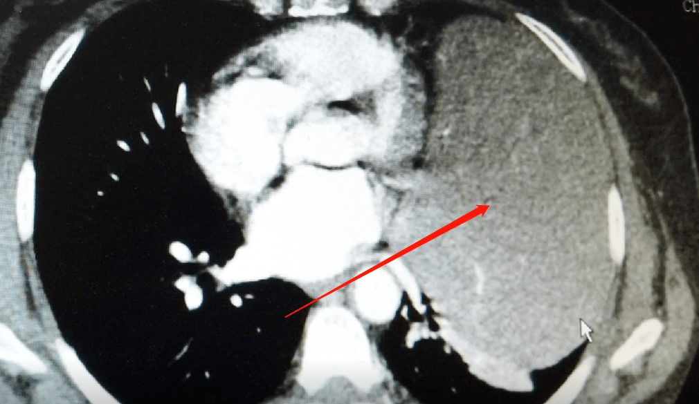 Ho khan nửa năm, người phụ nữ phát hiện khối u to như "quả bóng" treo trên phổi - 3