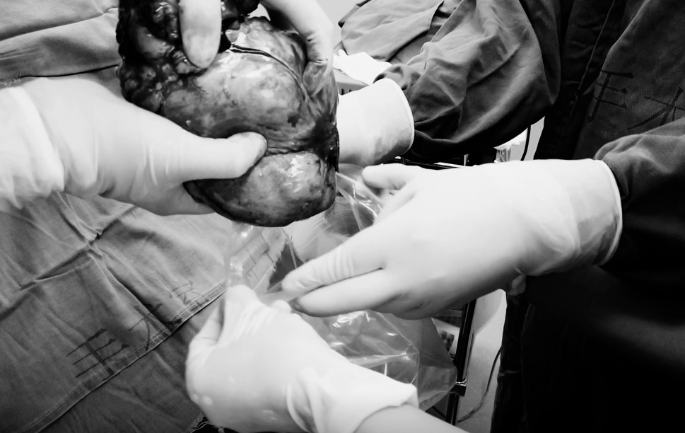 Ho khan nửa năm, người phụ nữ phát hiện khối u to như "quả bóng" treo trên phổi - 4