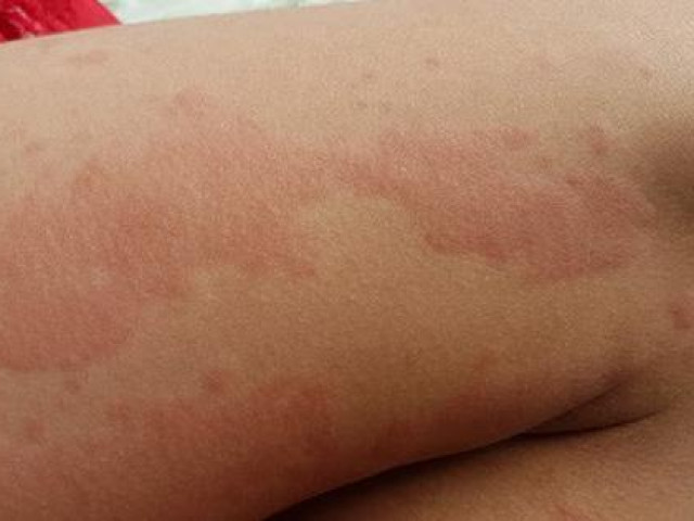 Sức khỏe đời sống - Nhiều người nổi mẩn ngứa "điên người", gãi đến toác da vào đầu hè, chuyên gia nói gì?