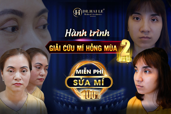 Dr.Hải Lê giải cứu thành công nhiều ca cắt mí mắt bị hỏng - 1