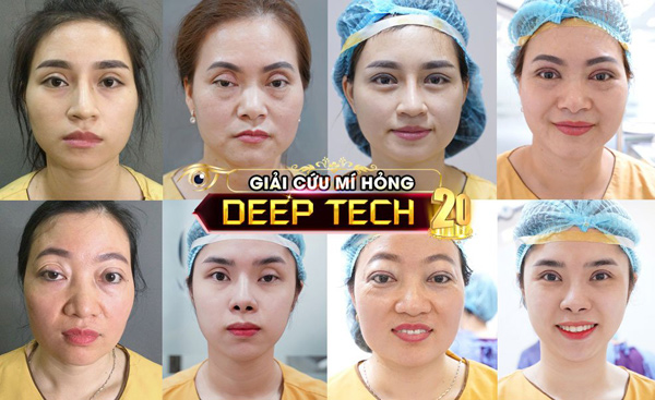 Dr.Hải Lê giải cứu thành công nhiều ca cắt mí mắt bị hỏng - 2