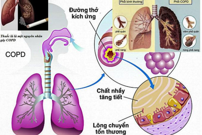 Ngoài thực hiện 5K và tiêm vắc xin - 8 lời khuyên để giữ cho phổi bạn khoẻ hơn - 1