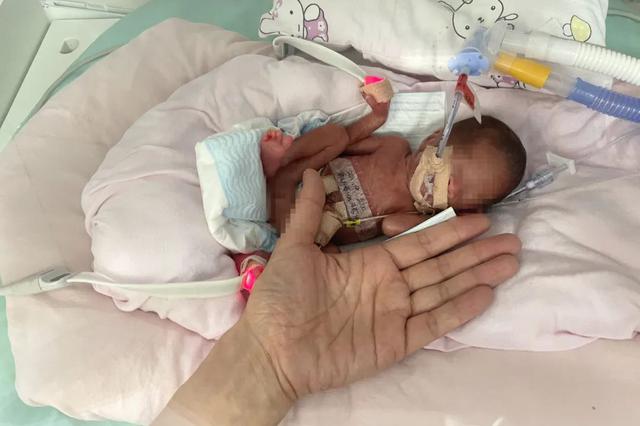 Kỳ tích sống sót của em bé sinh non nặng vỏn vẹn 450 gam, bé như bàn tay - 1