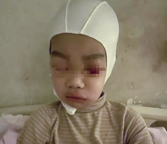 Cậu bé 9 tuổi bị chấn thương nặng và chảy máu trong hộp sọ sau khi bị thầy giáo giật tóc mạnh (Ảnh: SCMP).