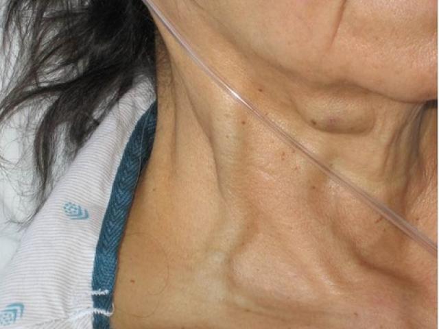 Sức khỏe đời sống - Nổi gân xanh cũng là dấu hiệu của bệnh lý nguy hiểm, cần lưu ý khi thấy ở những vị trí này