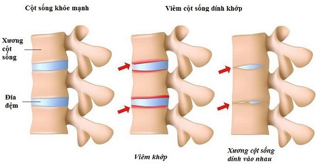 Căn bệnh hiếm gặp khiến “Nam vương châu Á” Châu Kiệt Luân phải khổ sở suốt bao năm - 6