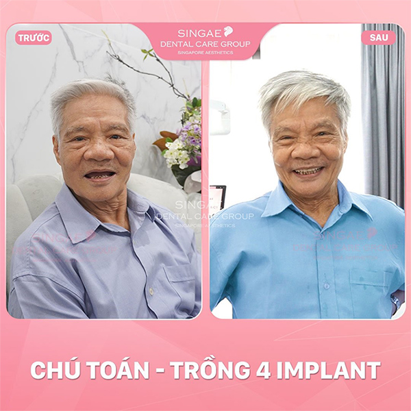 Dù đặt stent tim suốt 6 năm, chú Toán (74 tuổi) vẫn trồng thành công 4 Implant tại Singae