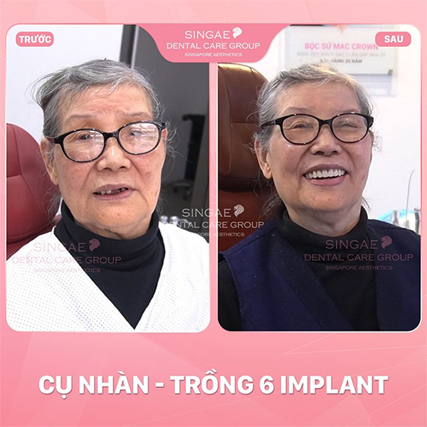 5 ca trồng răng Implant tại Nha khoa Singae gây tiếng vang tại Việt Nam - 2