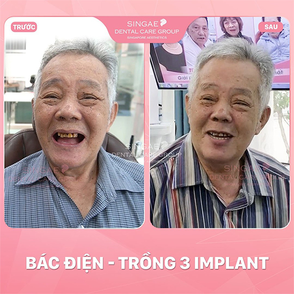 5 ca trồng răng Implant tại Nha khoa Singae gây tiếng vang tại Việt Nam - 3