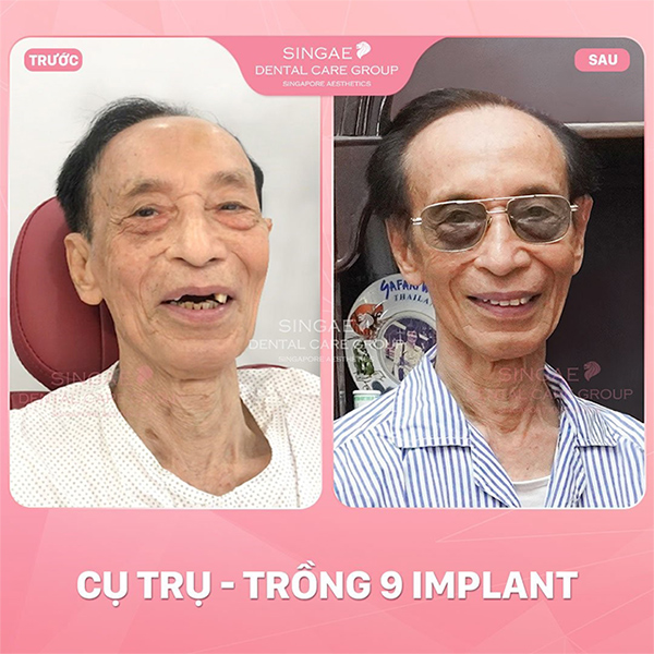 5 ca trồng răng Implant tại Nha khoa Singae gây tiếng vang tại Việt Nam - 4