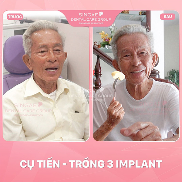 5 ca trồng răng Implant tại Nha khoa Singae gây tiếng vang tại Việt Nam - 5