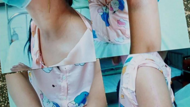 Chị Nghi liên tục bị chồng đánh vô cớ