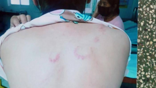Chị Nghi đang nằm điều trị tại Bệnh viện Long An với nhiều vết thương trên người