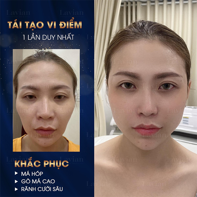 Tái tạo vi điểm – xu hướng làm đẹp thời thượng - 3