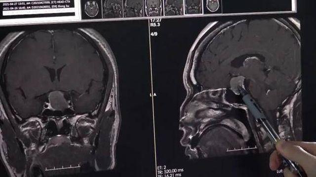 Hình ảnh ổ áp xe trong não của bệnh nhân