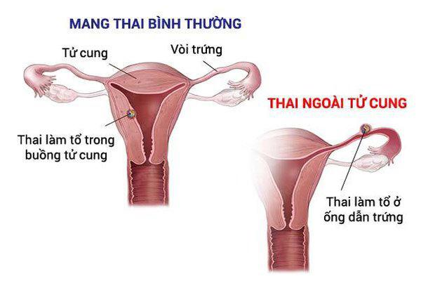 Bà bầu đi cách ly y tế, phải làm gì? - 3