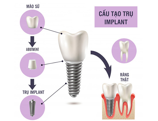 Lưu ý quan trọng khi điều trị mất răng cửa - 1