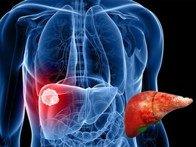 Sức khỏe đời sống - Thấy những dấu hiệu này cần lập tức đi khám để cứu lấy lá gan của bạn