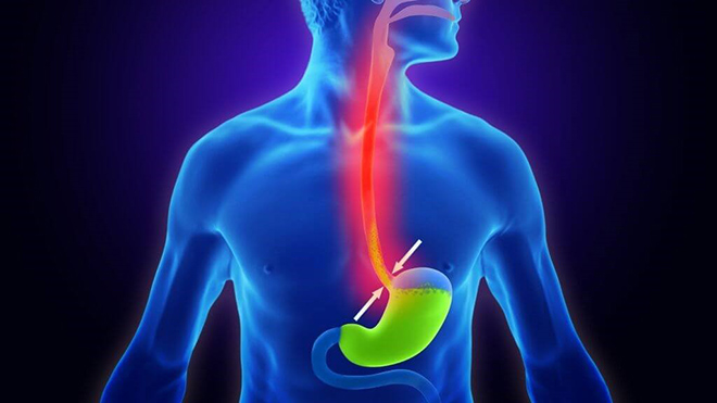 Trào ngược dạ dày gây ợ chua, nóng rát ngực, hầu họng