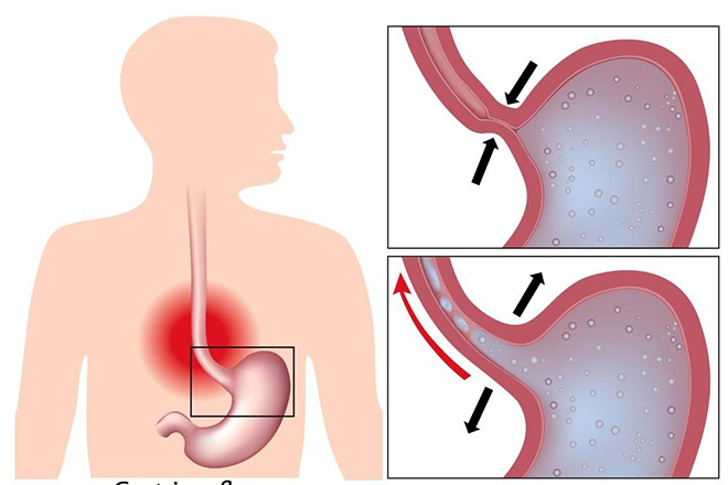 Cơ thắt thực quản dưới đóng chặt giúp ngăn trào ngược