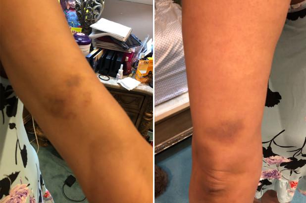 Các vết thương trên người Maria. 