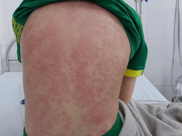 2 trẻ sốt cao, nổi ban đỏ khắp người vì mắc hội chứng hậu COVID-19
