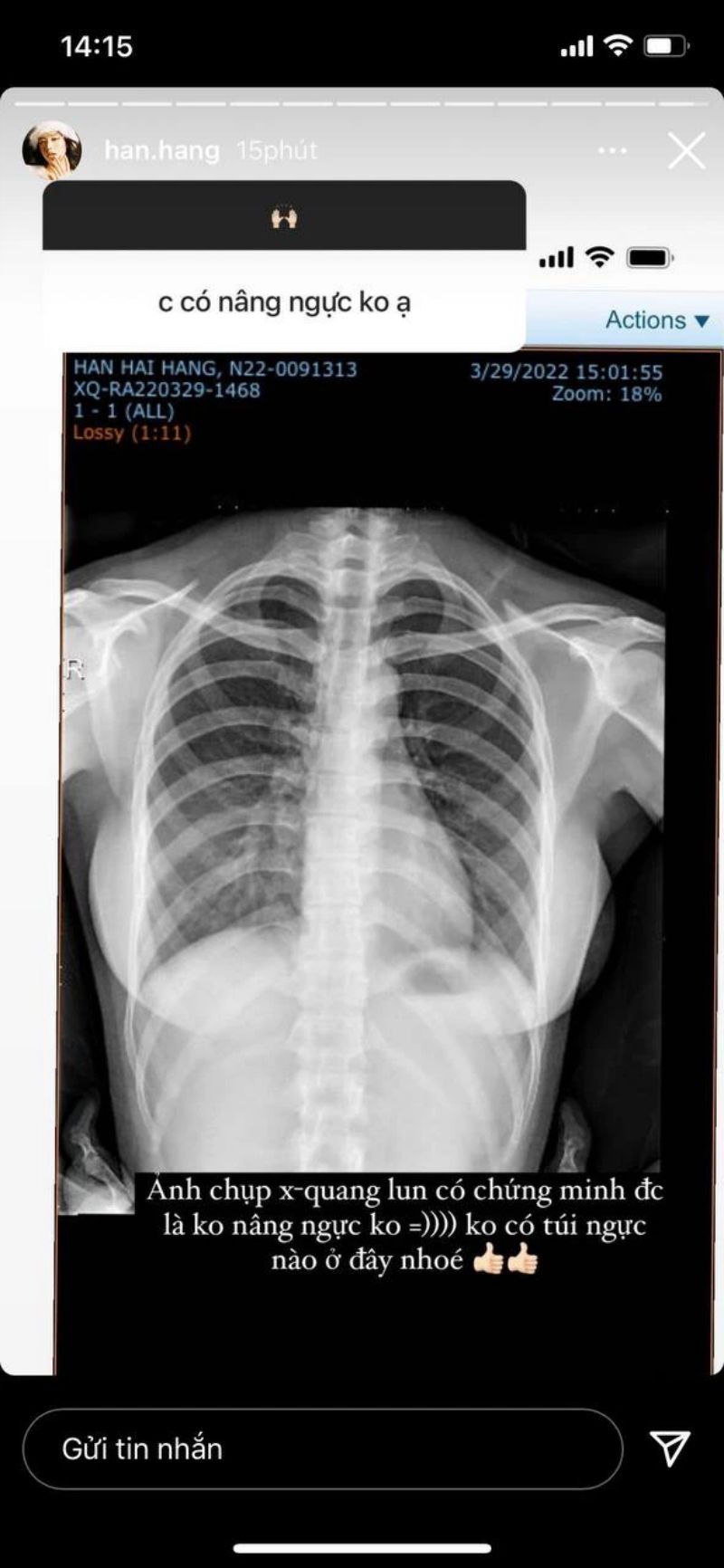 Hàn Hằng khẳng định không "dao kéo", tung hình chụp X-quang - 2