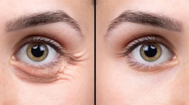 Fix aging with botox, good or bad?  - first