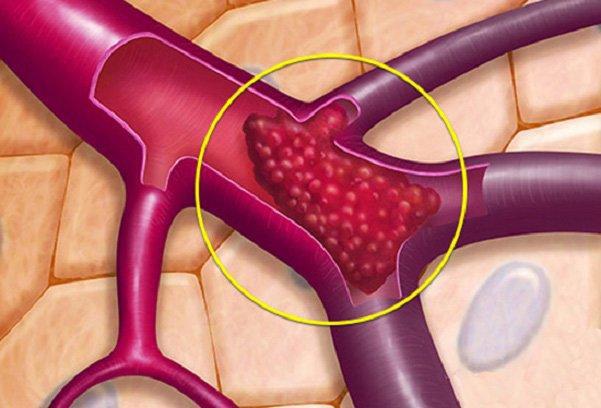 Những thực phẩm "dọn rác" cho mạch máu, ăn thường xuyên có thể ngừa đột quỵ - 1