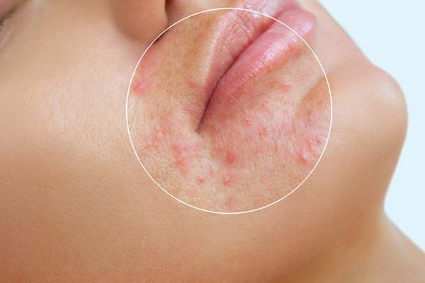 3 ways to treat acne that you don't know - 2