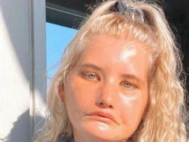 Bạn trẻ - Cuộc sống - Căn bệnh khiến cô gái có khuôn mặt luôn cau có, cả đời không thể cười