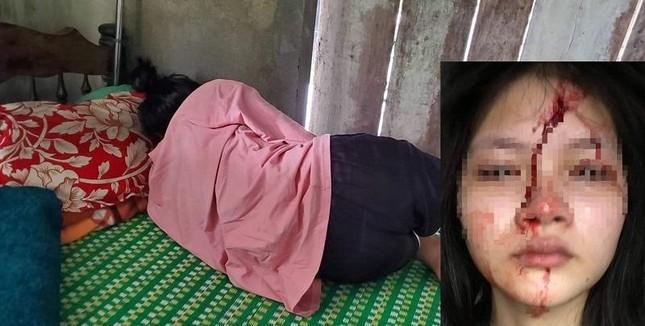 Nữ sinh Trường THPT Hương Trà (TT-Huế) bị bạn nữ học cùng trường hành hung phải nhập viện mới đây