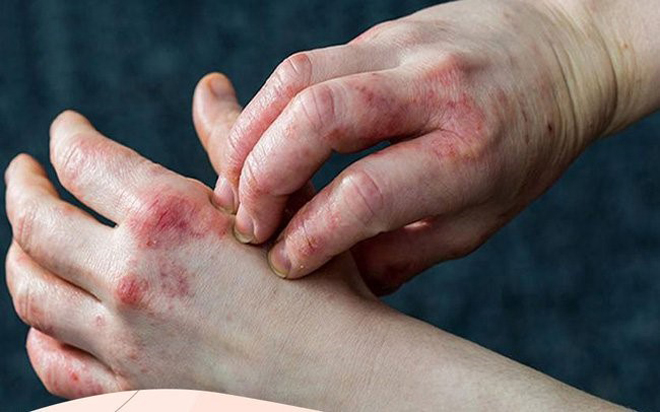 Biến chứng tiểu đường trên da làm bệnh nhân khó chịu, ngứa ngáy
