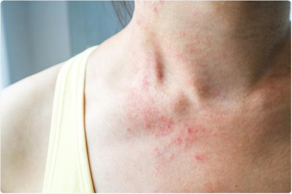 Self-deprecating because of acne and red skin that looks 'dirty' after COVID-19, many women treat the wrong way to make the situation worse - 1