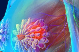 Sức khỏe đời sống - Thi thoảng đau nhói theo kiểu kim châm ở vú, cẩn thận với ung thư vú