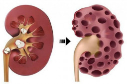 Sức khỏe đời sống - Trắc nghiệm: 2 quả thận "quý hơn vàng" cực dễ tổn thương nếu không biết điều này